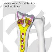 Locking Plate System - Double Medical Technology - PDF ...