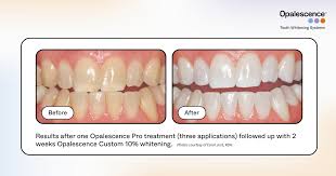 Transformations that shine ✨ Opalescence&trade; whitening products delivers safe,  reliable teeth whitening your patients will love 😁