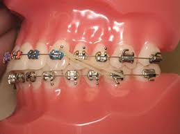 Elastic Wear | Feller Orthodontics