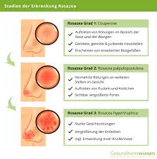 Behandlung der papulopustulosen rosazea der frau mit zyproteronazetat. Rosazea Symptome Ursachen Diagnose Behandlung