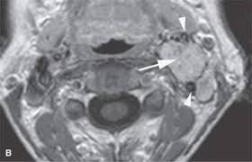 Image result for Chemodectoma