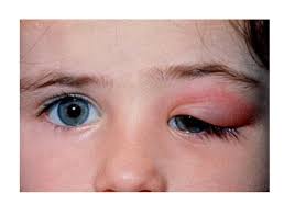 Image result for Dacryoadenitis