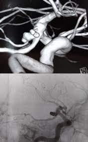 Across across,, eurys eurys : Datei Embolizacao Aneurisma Cerebral Jpg Wikipedia