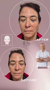 Фейслифтинг