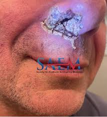 Image result for Forehead Regional Block