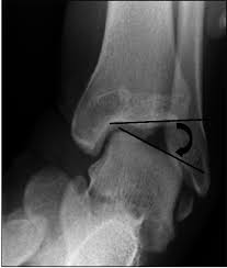 Image result for Talar Tilt