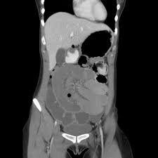 Pathophysiology to practice, a module fully funded by an unrestricted educational grant from abbott laboratories, reviews the current evidence and practical. Endometriosis Causing Recurrent Small Bowel Obstruction Radiology Case Radiopaedia Org