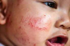 Image result for red rash face
