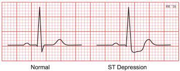 If you have experienced a heart attack, or are close with collateral circulation can also develop after a heart attack to help the heart muscle recover. What Can I Expect From My Doctor If Ekg Shows A Previous Heart Attack Quora