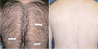 Because men tend to have thicker, coarser hair, laser hair removal can be a saving grace because of its ability to nix hair growth without causing the razor burn, ingrown hairs, or chronic irritation associated with more common methods of hair removal such as shaving, waxing and sugaring. Laser Hair Removal Ottawa Avantia Health