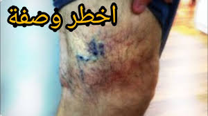 كنز جعله الله علاج دوالي الساقين ويشفي بسرعة، يقدم الدكتور مازن السقا طرق طبيعية لمحاربة الأوردة العنكبوتية ما هى دوالى الساقين ؟! ÙƒÙ†Ø² Ø¬Ø¹Ù„Ù‡ Ø§Ù„Ù„Ù‡ Ø¹Ù„Ø§Ø¬ Ø¯ÙˆØ§Ù„ÙŠ Ø§Ù„Ø³Ø§Ù‚ÙŠÙ† ÙˆÙŠØ´ÙÙŠ Ø¨Ø³Ø±Ø¹Ø© Ù…Ø­Ø§Ø±Ø¨Ø© Ø§Ù„Ø£ÙˆØ±Ø¯Ø© Ø§Ù„Ø¹Ù†ÙƒØ¨ÙˆØªÙŠØ© Ùˆ Ø§Ù„Ø¯ÙˆØ§Ù„ÙŠ Ùˆ Ø§Ù„Ø¨ÙˆØ§Ø³ÙŠØ±çš„youtubeè§†é¢'æ•ˆæžœåˆ†æžæŠ¥å'Š Noxinfluencer