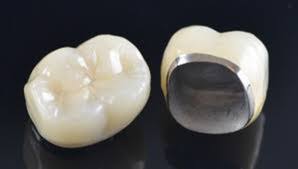 Let's start by explaining what a dental crown is. Types Of Dental Crowns And Cost A Complete Guide 2021