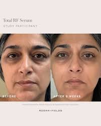 The results are in: Total RF Serum is the golden ticket to more youthful  looking skin. ✨ Can you spot the difference? Tell us below! Amp up your  anti-aging routine with our