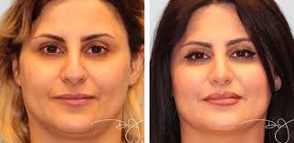 Rhinoplasty in Beverly Hills | Dr. J ...