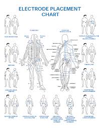 Tens Unit Placement Chart For Sciatica Www