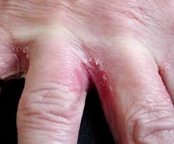 Image result for dermatitis contacta allergica