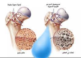 It is characterized by the softening and ultimate breaking. ØªØ¹Ø±ÙŠÙ Legg Calve Perthes Disease Ù…Ø±Ø¶ Ù„Ø¬ ÙƒØ§Ù„Ù Ø¨ÙŠØ±Ø« Ù‡Ùˆ Ø§Ù„Ø§Ø³Ù… Ø§Ù„Ø°ÙŠ ÙŠØ·Ù„Ù‚ Ø¹Ù„Ù‰ Ø§Ù„Ù†Ø®Ø± Ø§Ù„Ø¹Ø¸Ù…Ù‰ Idiopathic Osteonecrosis Ø¨Ù‡Ø´Ø§Ø´Ø© Ø±Ø£Ø³ Ø¹Ø¸Ù…Ø© Ø§Ù„ÙØ®Ø° Capital Epiphysis ÙˆÙ‡Ùˆ