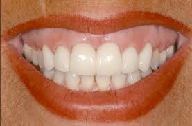Jul 12, 2018 · three main types of splints are used to correct loose teeth including: The Guide To When And When Not To Splint Restorations Spear Education
