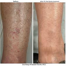 Image result for liver spots on legs