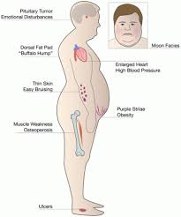 Cushing S Syndrome Columbia University Department Of Surgery