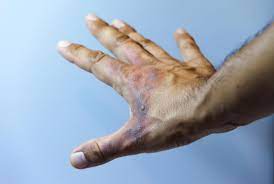 This picture was taken the day after the accident. First Degree Burn Definition Symptoms And Treatments
