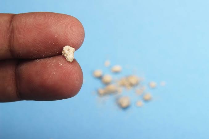 How to Know if You're Experiencing Kidney Stones - Women's Health Arizona