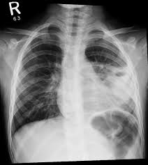 How To Read Chest X Ray X Ray Respiratory Therapy Radiography