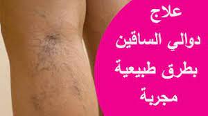 علاج دوالى ااساقين دكتور مازن السقا / archives des ù ø§ø²ù ø§ù ø³ù ø§ ø§ù øµù ø­ø© 4 ù ù 6 ù ø§ø±ù ù ø·ù ù ø¯ù ù ø³ maroc tendance :. Ø¹ÙØ§Ø¬ Ø¯ÙØ§ÙÙ Ø§ÙØ³Ø§ÙÙÙ Ø¨Ø·Ø±Ù Ø·Ø¨ÙØ¹ÙØ© ÙØ¬Ø±Ø¨Ø© Youtube
