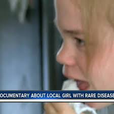 Local girl fighting extremely rare Sanfilippo Syndrome focus of new  documentary