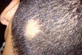 Negli uomini, si verifica un progressivo diradamento nell'area . L Alopecia Areata La Caduta Di Capelli A Chiazze