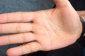 Liver cirrhosis and its many causes including alcohol abuse. Derm Dx A Teen With Palmar Desquamation Clinical Advisor