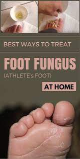 Best Ways To Treat Foot Fungus Athlete S Foot At Home Itchy Feet Remedy Dry Cracked Feet Foot Remedies