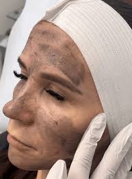 Laser Tattoo Removal in Hoboken