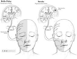 Bell's palsy is generally temporary, and most people will recover within 9 months. Anatomy Stroke Vs Bells Palsy