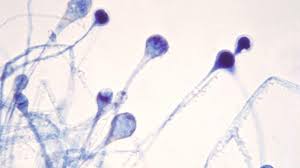 Es recomendable es que lo apliques al menos 3 veces al día. Hongo Negro Un Desafio Mayor Que El Coronavirus India Reporta Casi 9 000 Casos De Mucormicosis