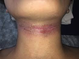 Image result for dermatitis contacta allergica