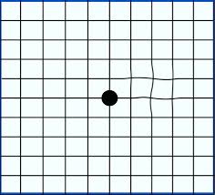 An Amsler Grid Showing Mild Distortion Loose Lips Sink