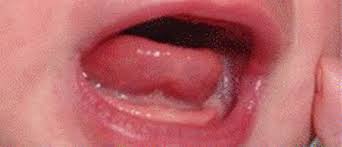 Frenillo Lingual Corto O Anquiloglosia Alba Lactancia Materna
