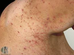 Image result for scabies symptoms