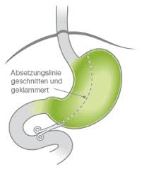 Schlauchmagen Op In Munchen Schneller Satt Viszera