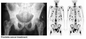 Advanced prostate cancer means that a cancer that began in the prostate gland has spread to another part of the body. Prostate Cancer Treatment Symptoms Causes Diagnosis
