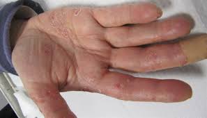 These fungi are responsible for: Scaling Rash On The Palms Clinical Advisor