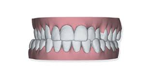 Jeder wünscht sich gesunde, schöne und vorallem gerade zähne. Invisalign Unsichtbare Zahnspange Praxis Illner