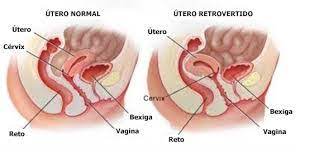Quem Tem Utero Retrovertido Pode Engravidar Mulher Descomplicada