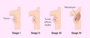 If breast cancer is diagnosed at an early enough stage, it's treatable. How Can Breast Cancer Be Detected Symptoms Treatment