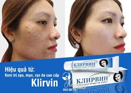 Kem trị sẹo, mụn, rạn da cao cấp Klirvin 25g của Nga