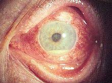 Uveitis is categorized according to the part of the uveal tract that is affected. Uveitis Wikipedia
