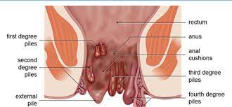 Pile foundations are deep foundations. Hemorrhoid Pile Mahaba Herbal Limited