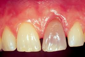 Image result for Tooth Discoloration