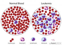 The effects of the blood cancer will depend on the exact type of cancer and which blood cells are affected. What Are The Different Types Of Myeloid Leukemia
